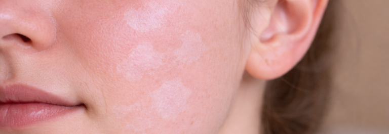 Pityriasis Alba on a lady's cheek