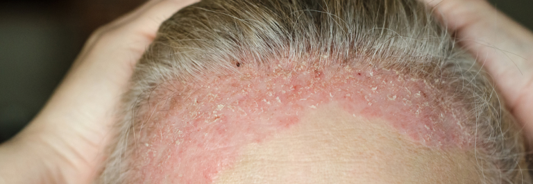 person pulling back hair, revealing scalp psoriasis