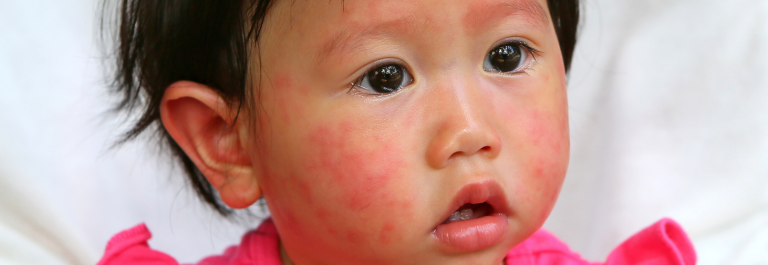tolder in a pink top with red facial rash