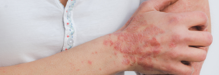 Person with psoriasis on hand scratching their arm.