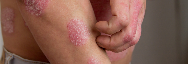 person scratching psoriasis plaque on arm