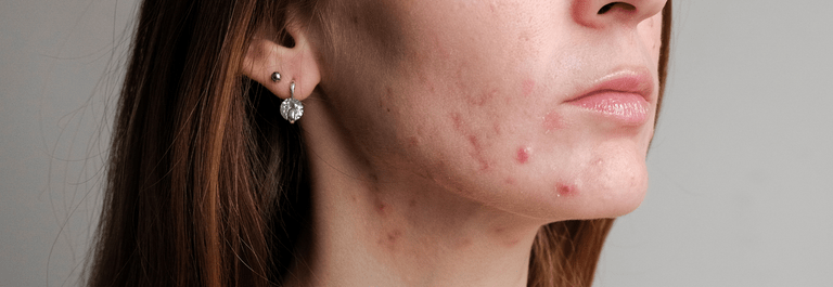 How to Take Care of Dry, Acne Prone Skin