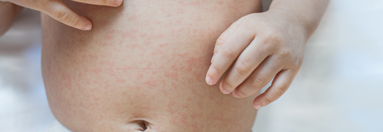 infants stomach with roseola rash
