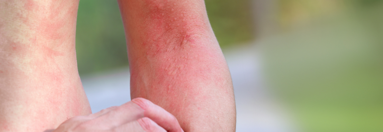 itchy red rash on arm