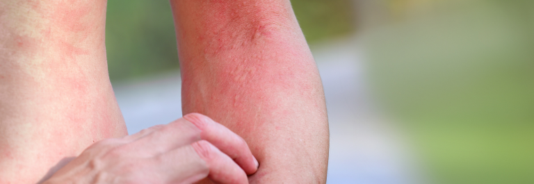 person itching their inflamed red forearm 