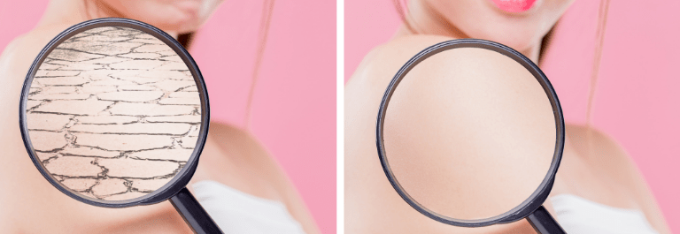 Is All Dry Skin Eczema?