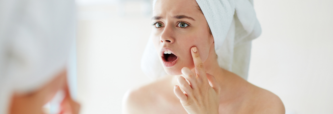 Natural Skin Care Products for Acne