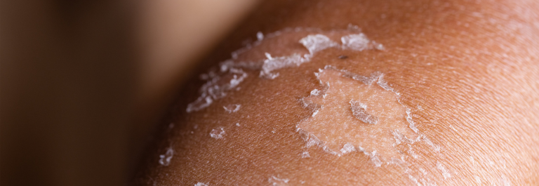 peeling skin on shoulder