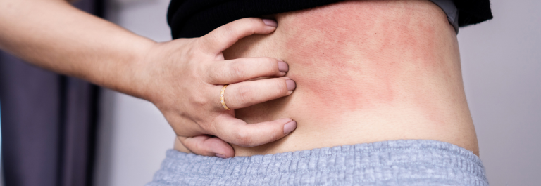 treatment for pityriasis rosea