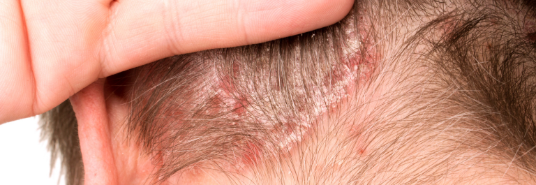 man showing psoriasis on scalp