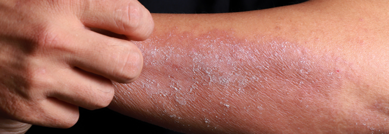 person scratching red dry arm