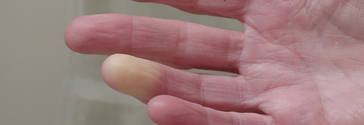 Healing Topical Steroid Withdrawal Naturally