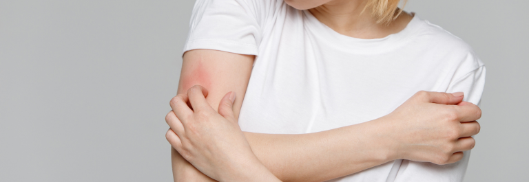 person in white shirt scratching rash on arm due to textile dermatitis
