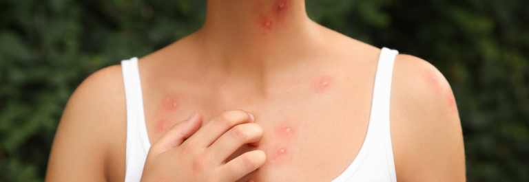 woman in white tank top scratching at chest rash