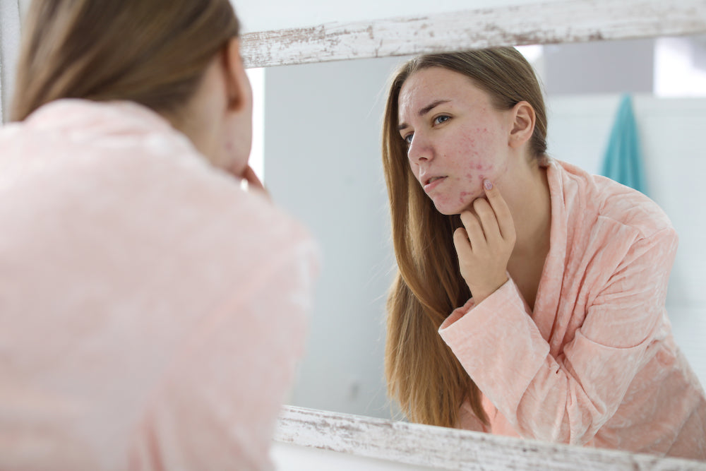 manuka honey on acne, manuka honey for acne, manuka honey acne treatment
