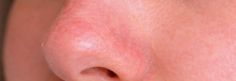 What You Need to Know About Nose Eczema