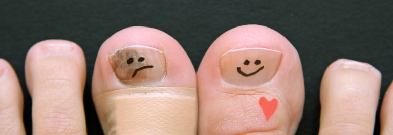 nail psoriasis: two big toe nails, one with a frown and the other with a happy face