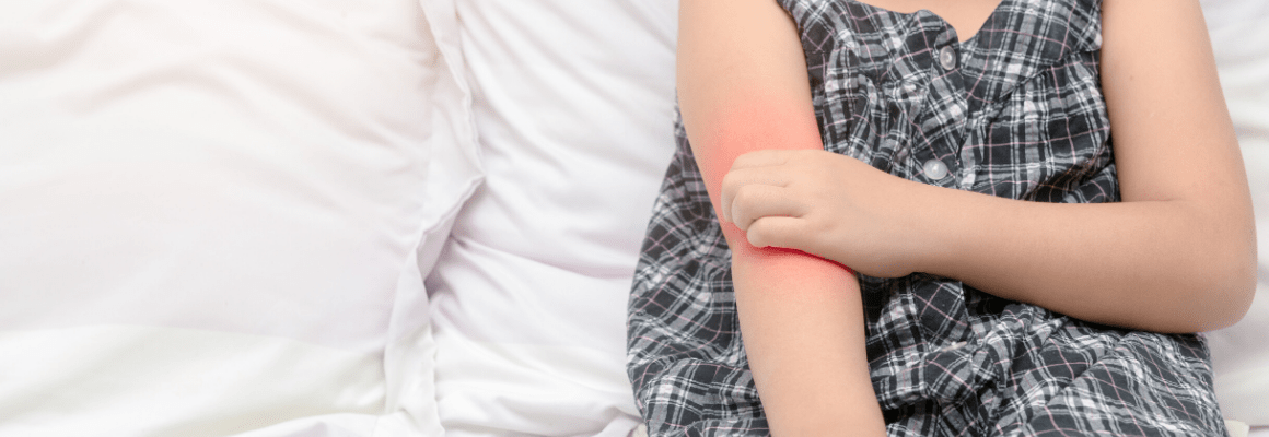 child holding her red, irritated arm