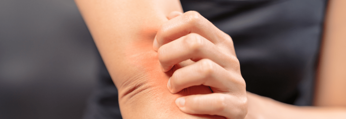 Atopic dermatitis vs. eczema - woman scratching arm
