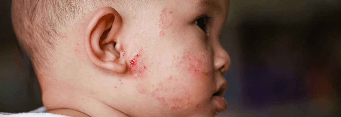 Is it Baby Acne or Eczema?
