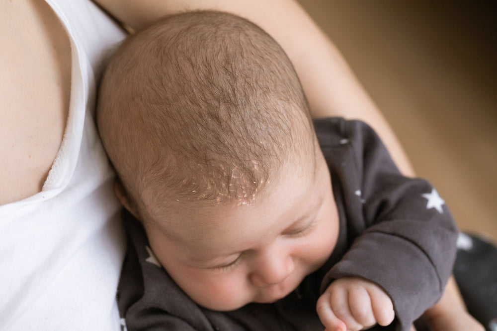 How To Soothe Baby Cradle Cap Naturally