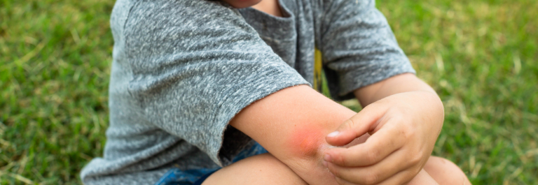 Little boy holding blister from bug bite on elbow 
