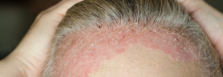 person pulling back hair, revealing scalp psoriasis 