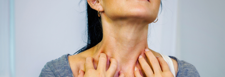 woman scratching rash on neck