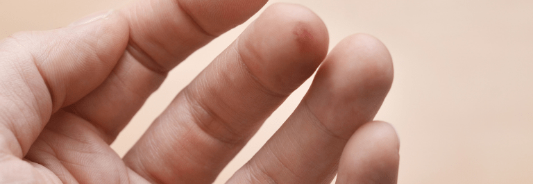 How to Manage Cracked Skin on Fingertips Around Nails