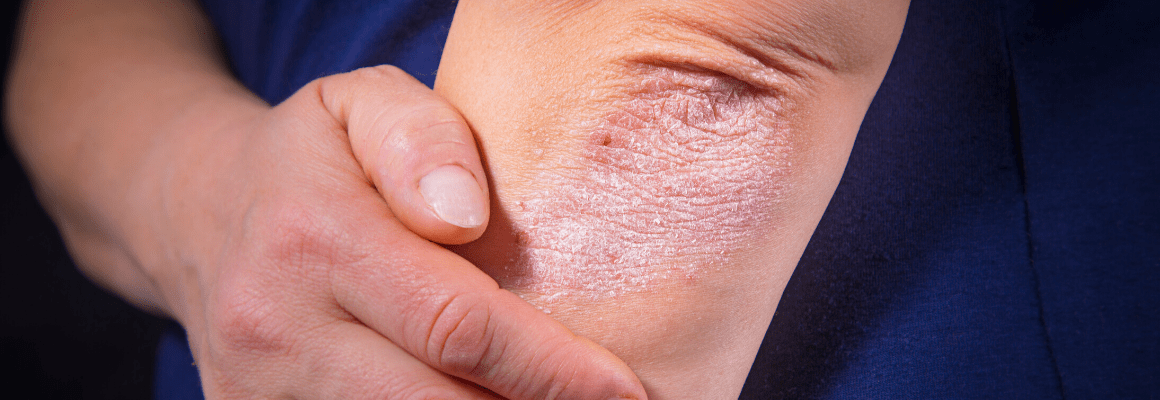 Psoriasis and Eczema - Woman showing psoriasis on elbows