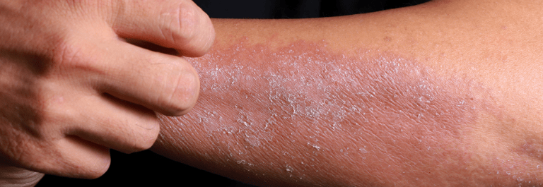 Can I Get Disability For Eczema Benefits?
