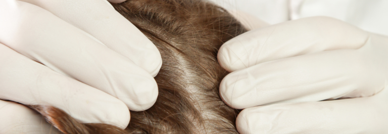 person with white gloves parting hair to show scalp psoriasis