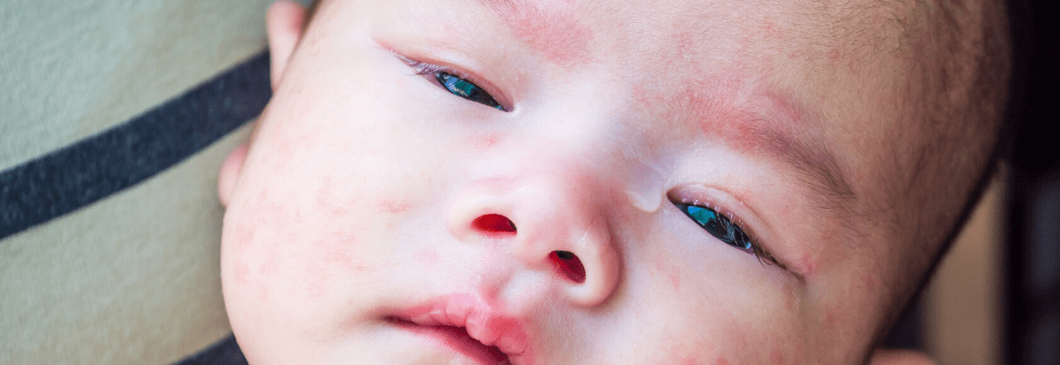 Eye Eczema - baby with rash on face