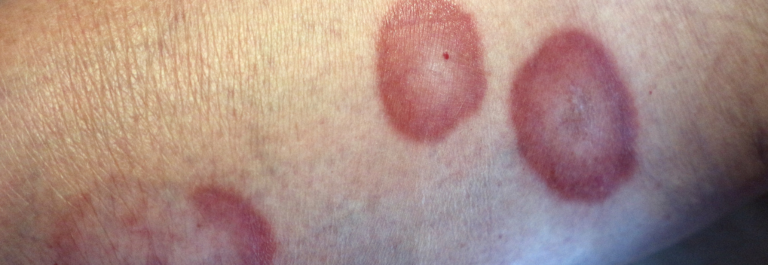 Granuloma Annulare:  circular rash or raised, skin-colored bumps