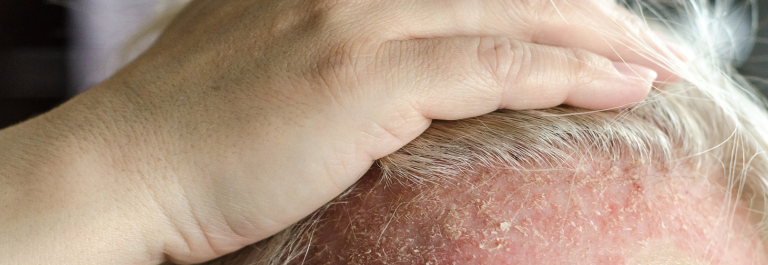 person touching scalp covered by psoriasis