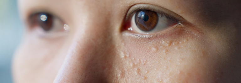 person staring into the distance with milia under their eyes 