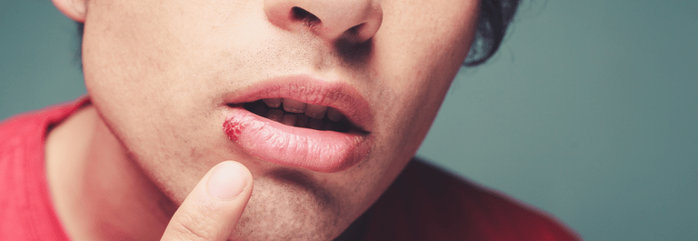 How to Use Honey for Cold Sores