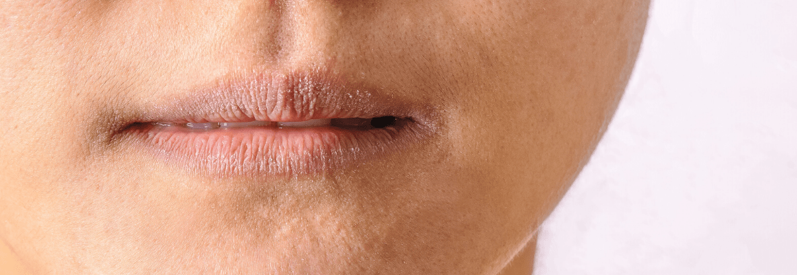 Eczema on Lips - chapped lips