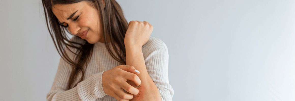 Your Guide to Natural Dermatitis Treatment
