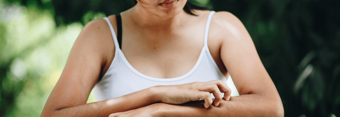 Nummular eczema - woman scratching arms