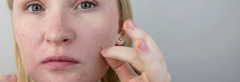 woman with blue eyes picking at peeling skin on her face