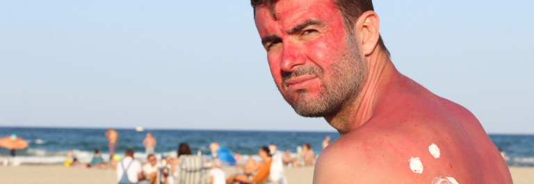 A sunburnt man sitting at the beach