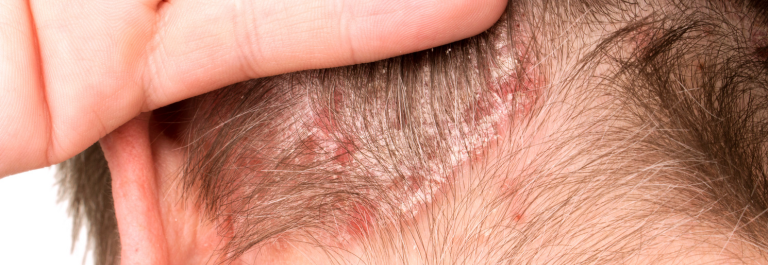 man showing psoriasis on scalp 