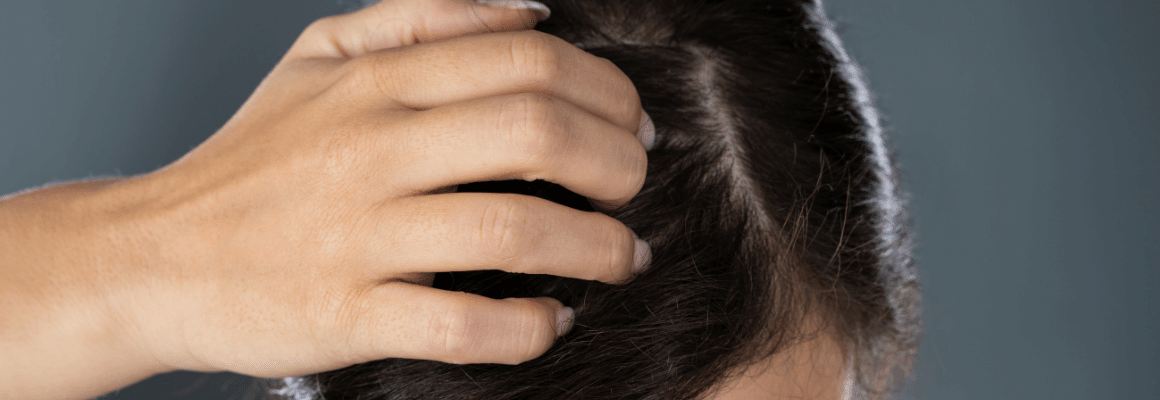 seborrheic dermatitis vs. psoriasis - woman scratching her scalp at roots