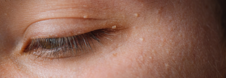 close up image of an eye with milia around it 