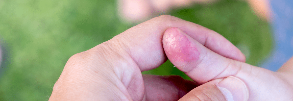 Eczema Blisters - hand with irritated finger