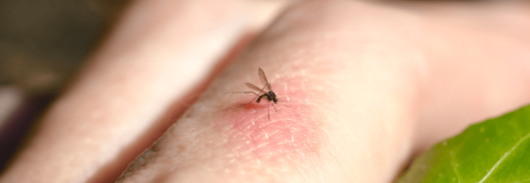 Treating Mosquito Bites Naturally