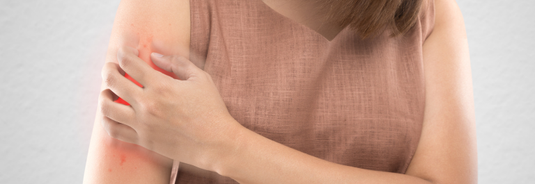 woman scratching dermatitis on her upper arm