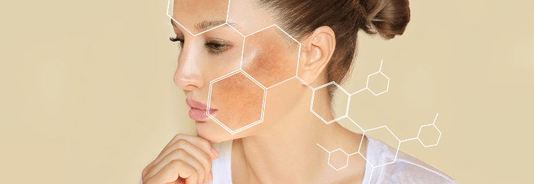 Tinea Versicolor - Molecules on woman's face
