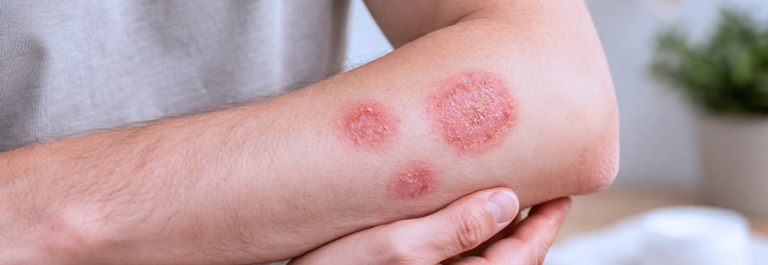 discoid eczema patches on a person's arm